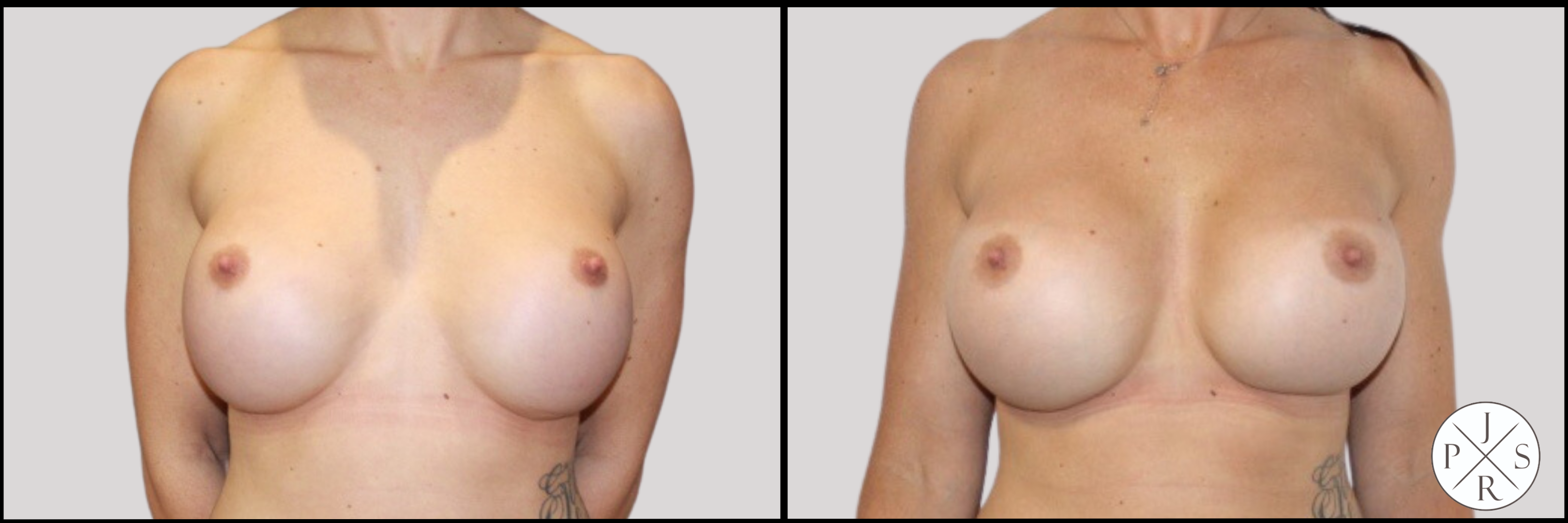 Breast Revision Before & After Image